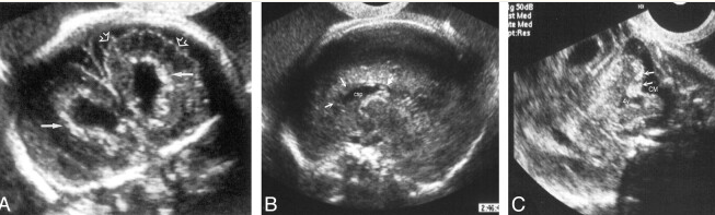 Calcificação periventricular